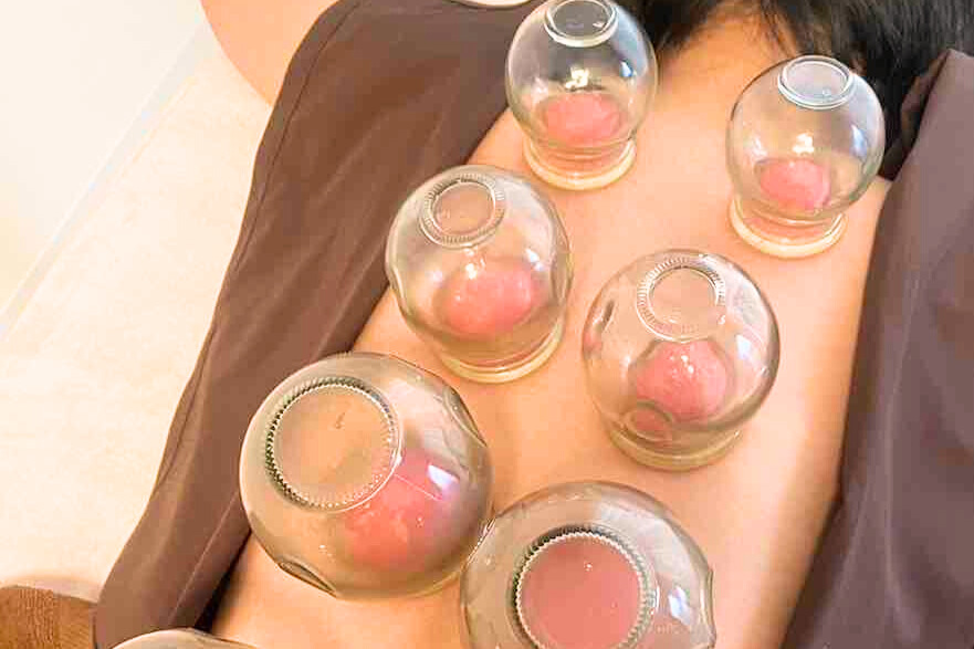 背中にカッピングをしている女性,吸い玉,吸角