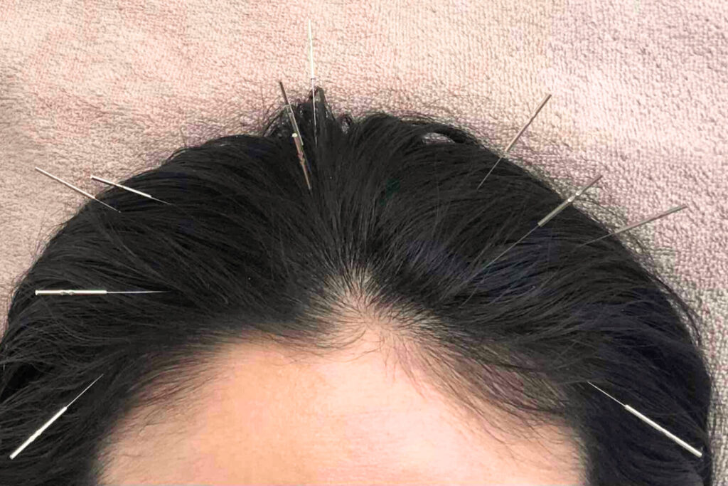 頭に鍼をする女性,頭皮鍼